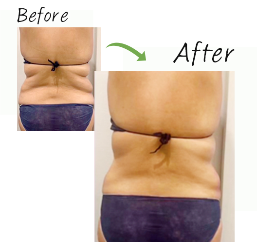 脂肪冷却装置 - 不二クリニック