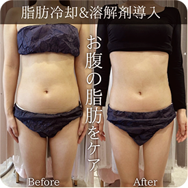 お腹の脂肪をケア