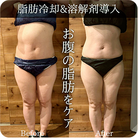 お腹の脂肪をケア