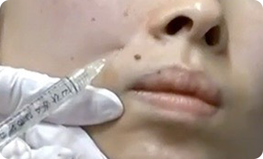 ヒアルロン酸注射