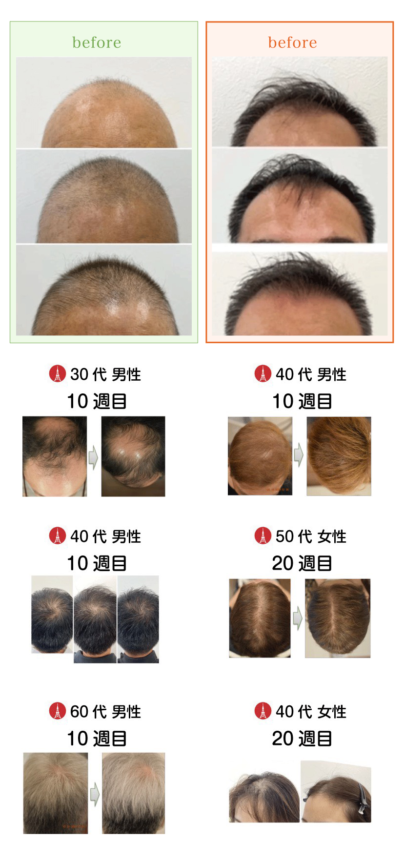 増毛注射 ビフォーアフター